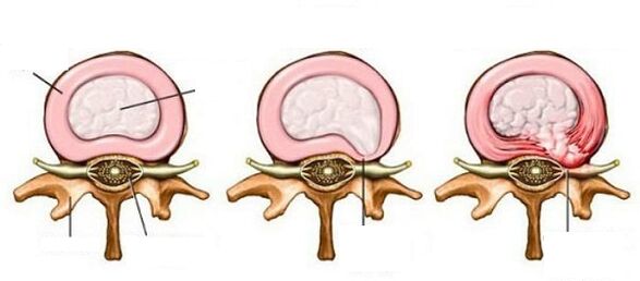 Intervertebral Hernia sa cervikalnom osteohondrozom