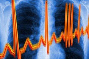 Srčana aritmija za osteohondrozu
