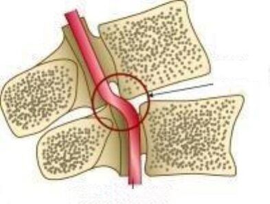 Vail Artery sindrom